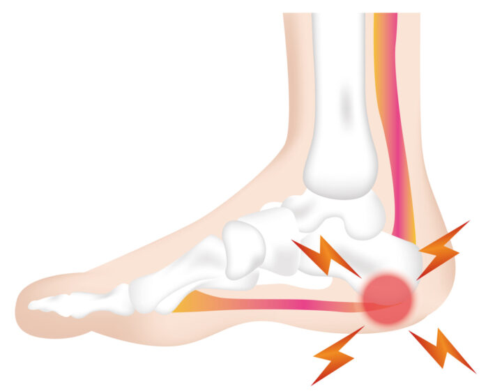 サーバー病とは何ですか?